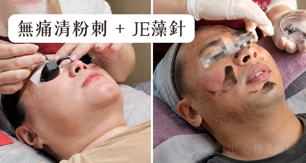 JE心怡美顏館 無痛清粉刺 JE藻針 2