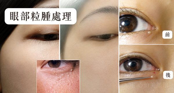 JE心怡美顏館 眼部粒腫處理