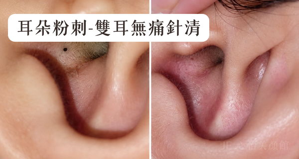 JE心怡美顏館 耳朵粉刺 雙耳無痛針清 1